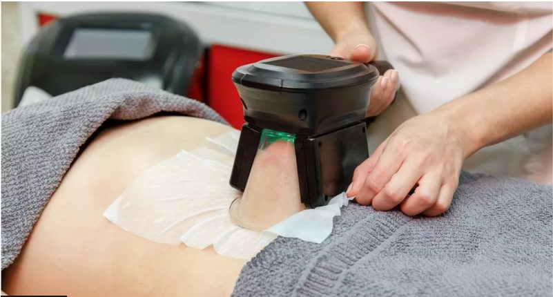 Women getting Cryolipolysis Services