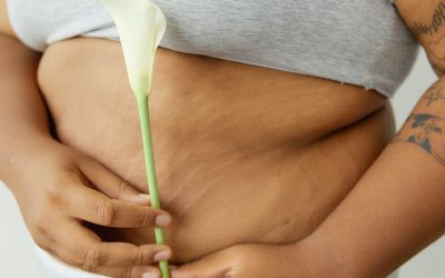 Stretch Marks: Can They Be Prevented?