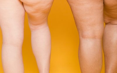 How to Reduce the Appearance of Cellulite Naturally